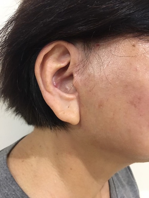 Surgical Scar and Earlobe Position 1 Surgical Scar and Earlobe Position 1